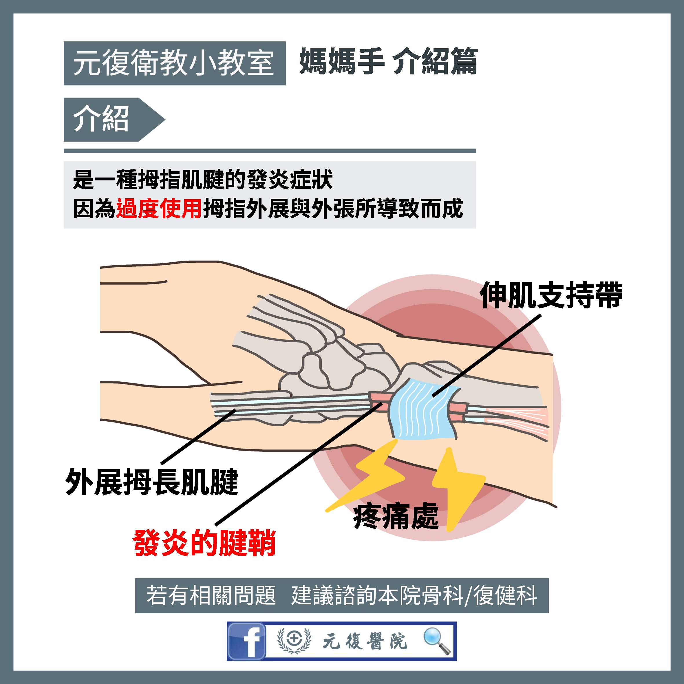 元復衛教小教室 / 了解媽媽手：症狀、好發族群及自我檢測方法