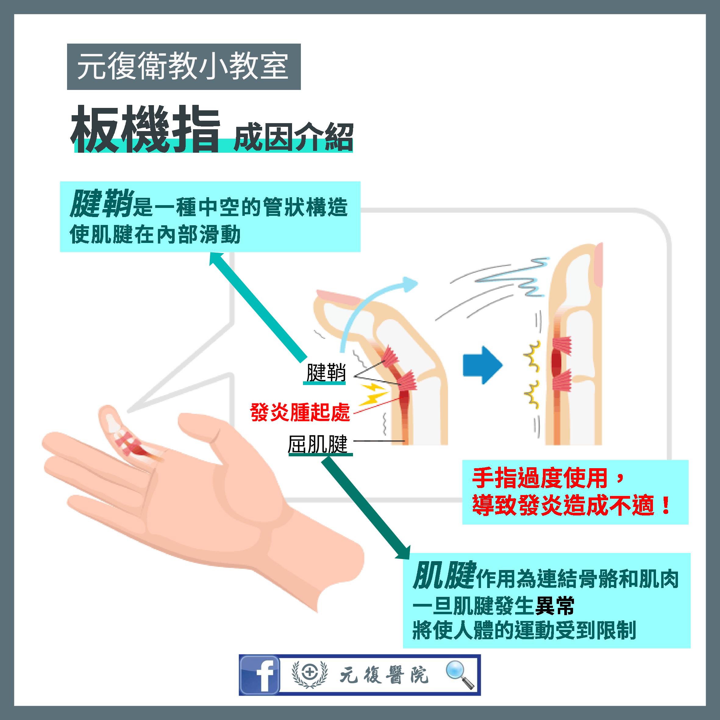元復衛教小教室 / 肌腱鞘發炎/板機指：家庭主婦和鍵盤戰士必讀的健康警示