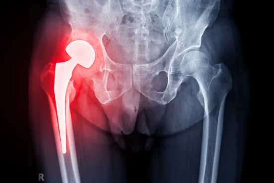 髖關節痛緩解與治療：從保守療法到復健運動