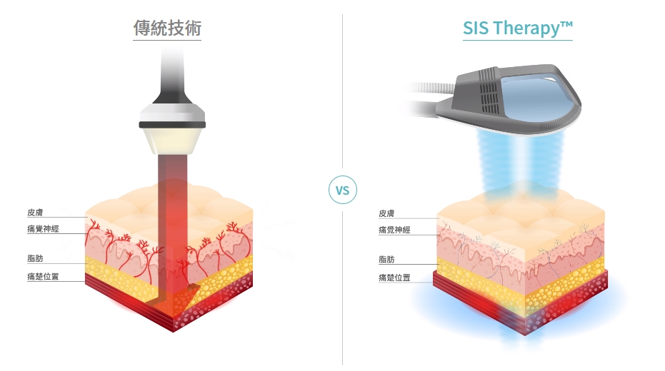 SIS超磁場治療